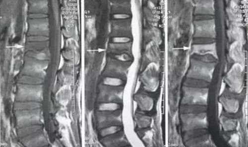 腰椎结核的症状 腰椎结核 腰椎结核的症状