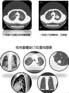 头颈部癌症 肺癌CT筛检有助早期发现头颈部癌症