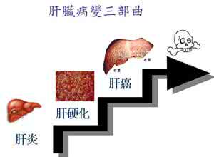 肝炎会变成肝癌吗 超过八成肝癌由肝炎导致