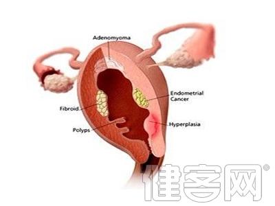 子宫癌怎么治疗 子宫癌怎么治疗 子宫癌的疾病治疗