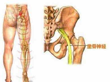 坐骨神经痛的锻炼方法 坐骨神经痛的饮食保健方法