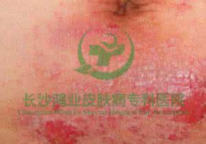湿热皮肤病 湿热皮肤病 远离“热”出来的皮肤病