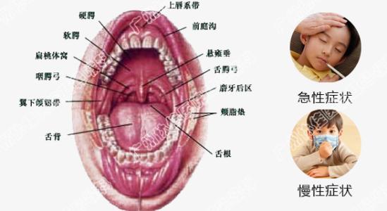 扁桃体炎症状及表现 扁桃体炎的症状 六种类型表现各不同