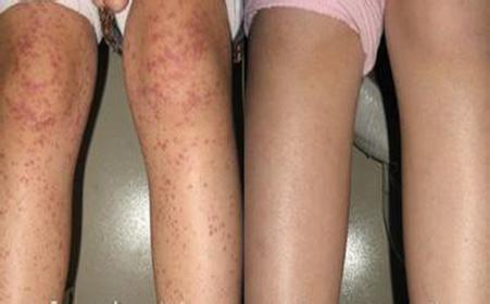 紫癜性肾炎治疗方案 紫癜性肾炎如何治疗 如何护理小儿紫癜肾炎