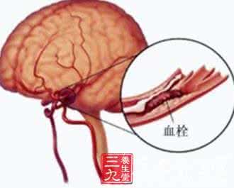 脑血栓能治好吗 脑血栓