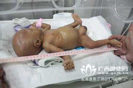 如何判断早产儿脑瘫 如何判断早产儿脑瘫 早产儿脑瘫要及时发现
