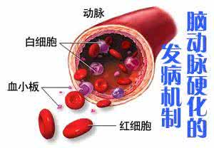 脑动脉硬化症 脑动脉硬化症是由什么原因引起的？