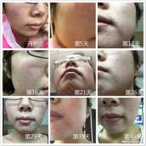 激素脸怎么治疗修复 激素脸怎么治疗修复 激素脸怎么治疗?