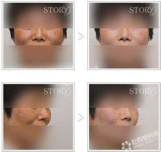 色斑和黄褐斑的区别 色斑和黄褐斑的区别 如何快速消除黄褐斑?去掉色斑还肌肤原有嫩白