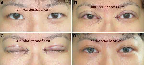 内眦赘皮和开眼角区别 内眦赘皮必须开眼角吗 根据内眦赘皮的严重程度选择开眼角手术