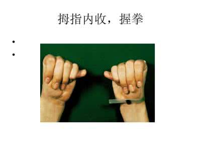 马凡氏综合征 马凡氏综合征 马凡氏综合征在临床上的表现