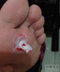 脚钉与鸡眼的区别图片 脚钉怎么治 为什么会长鸡眼