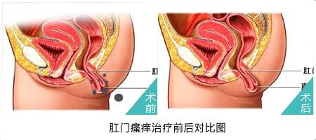 肛门裂口如何治疗 【治疗肛门裂口民间土方】