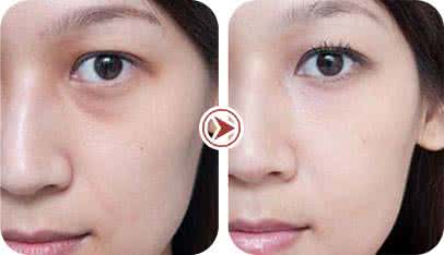 上睑松弛整形术 上睑松弛整形术 无痕去眼袋手术