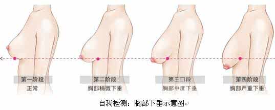 产后乳房萎缩下垂 产后乳房萎缩下垂 女人的乳房为什么会萎缩