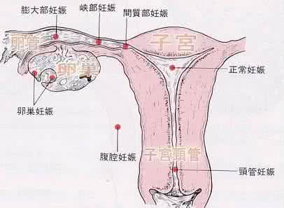 狐臭的病因与发病机理 病因:宫外孕的发病机理