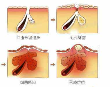 毛孔堵住了怎么办 堵住4个让毛孔增大的护肤漏洞