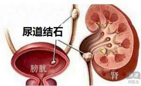 尿道结石吃什么食物好 尿道结石吃什么食物好 尿道结石病因