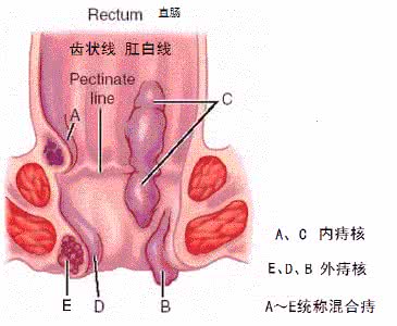 肛门出血是什么原因 肛门出血是什么原因 哪些因素会导致肛出血