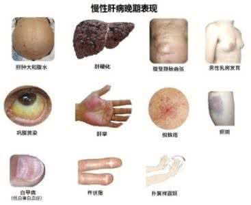 得了肝病是什么症状 肝病的症状是什么 它有哪些临床表现