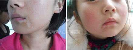 白斑病是什么原因引起 白斑病是什么原因引起 宫颈白斑是什么原因引起的