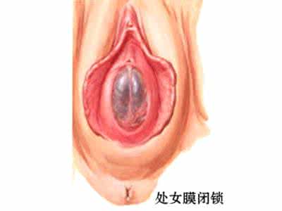 鼻孔整形术 处女膜整形术 处女膜闭锁修复整形术后的特点