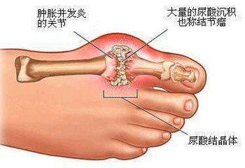 痛风怎么诊断治疗 痛风怎么诊断治疗 痛风性心肌病诊断治疗