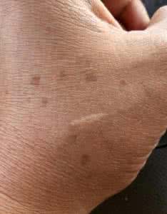 手背上长老年斑怎么办 手上长了老年斑怎么办