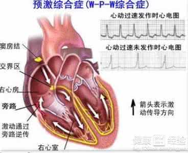 心脏预激综合征症状 心脏预激综合症的症状 常见的临床表现