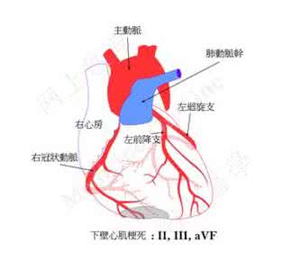 急性心肌梗塞的并发症 急性心肌梗塞的急救