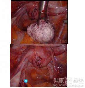 子宫内膜息肉怎么检查 宫颈息肉怎么检查出来 子宫内膜息肉的检查