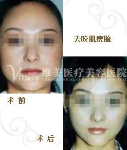 咬肌怎么变小 咬肌怎么变小 怎么让咬肌变小