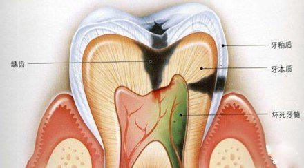 蛀牙牙痛怎么止痛 蛀牙痛怎么办 这些方法教你止痛