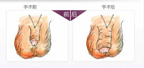 怎么让阳具变粗 科学安全的阴茎增粗手术怎么做