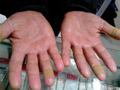 如何治疗湿疹最有效 治疗湿疹最有效的方法 2个老偏方可能有效清除湿疹,1个针对成人,1个针对儿童