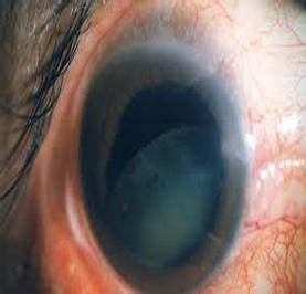 白内障的临床表现 白内障的症状 它有哪些临床表现