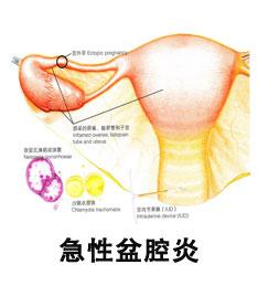 盆腔炎是什么症状 盆腔炎是什么症状 盆腔炎症状