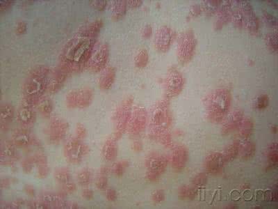 亚急性皮肤型红斑狼疮 什么是亚急性型红斑狼疮