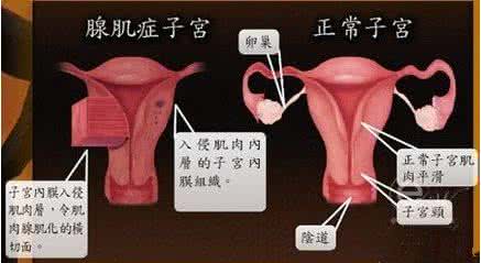 子宫腺肌症治疗方法 子宫腺肌症的症状 三大方法治子宫腺肌症