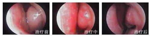 鼻窦炎的症状及治疗 鼻窦炎的症状 食疗法治鼻窦炎