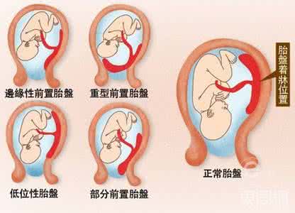 胎盘滞留的原因 胎盘滞留怎么办