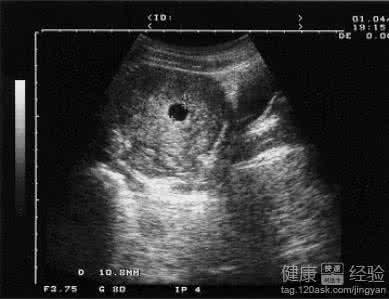 子宫内膜炎b超诊断 b超能检查子宫内膜炎吗 子宫内膜炎b超诊断
