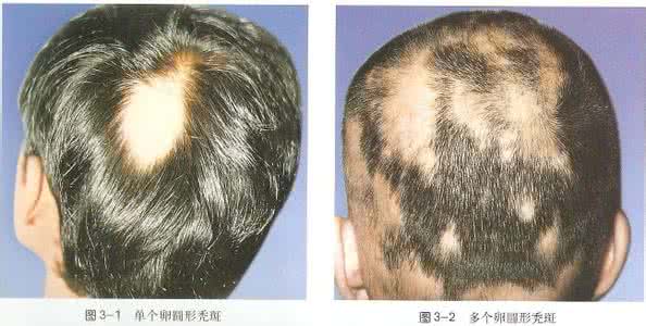 斑秃治疗最快的偏方 斑秃治疗最快的方法 治疗斑秃的偏方