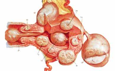 子宫肉瘤的早期症状 子宫肉瘤是怎么形成的 子宫肉瘤症状