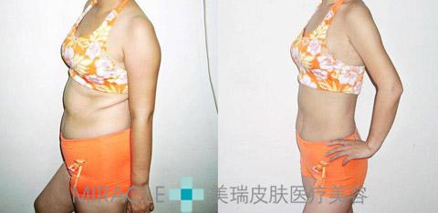 中医针灸减肥原理 针灸加食疗减肥效果更明显 中医减肥法