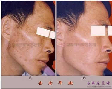 老年斑治疗适合哪些人 老年斑治疗 治疗老年斑应该吃些什么