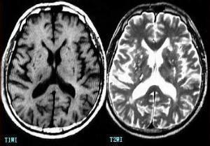 多发性腔隙性脑梗塞 多发腔隙性脑梗塞 什么是多发腔隙性脑梗塞