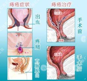 痔疮 激光手术 女人痔疮 让痔疮从女人身边跑光光