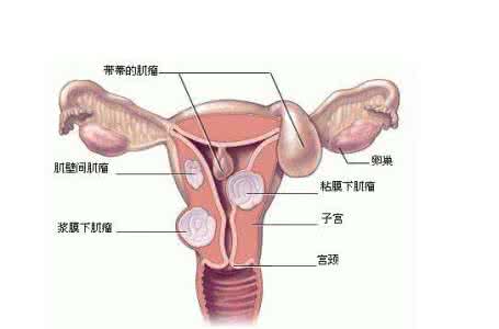 怎样预防子宫肌瘤长大 预防子宫肌瘤的方法 子宫腺肌瘤的预防方法