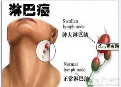 淋巴癌是怎么形成的 淋巴癌的形成及预防